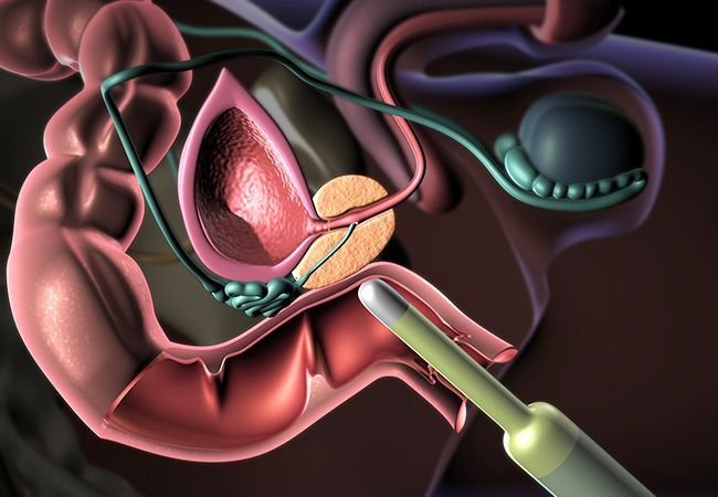 Prostate and urinary system illustration